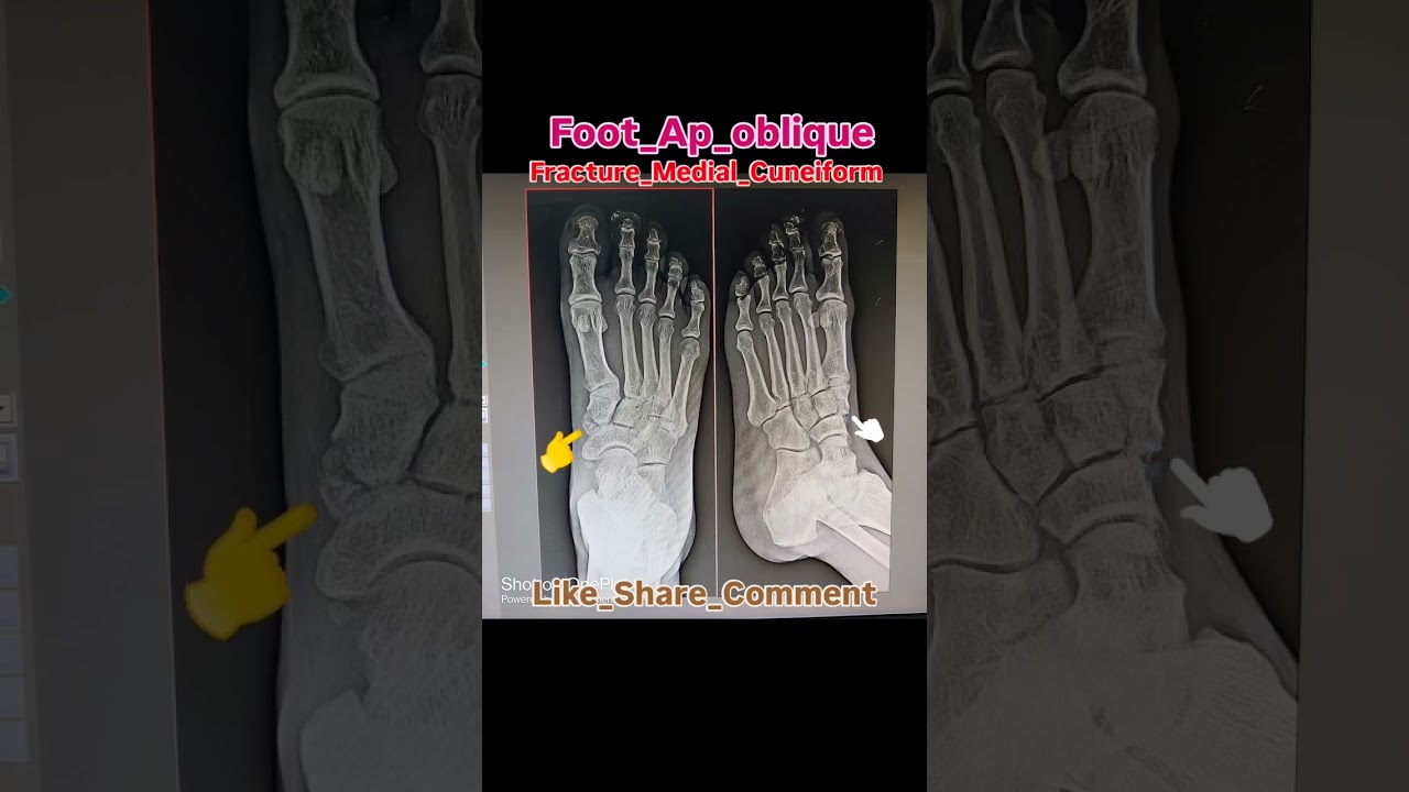 Foot medial cuneiform fracture | #medicalstudent #radiology ##health #shorts #xraydigitalimage01