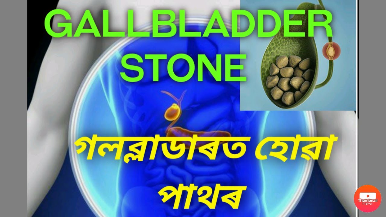 GALLBLADDER STONE...গলব্লাডাৰত হোৱা পাথৰ