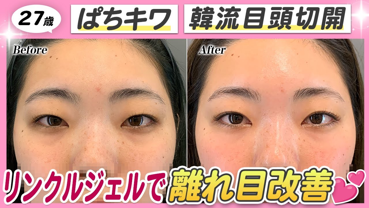 【26歳 目元整形】離れ目さん必見👀✨上まぶたのデザインで印象はここまで変わる【ぱちキワ＋目頭切開】