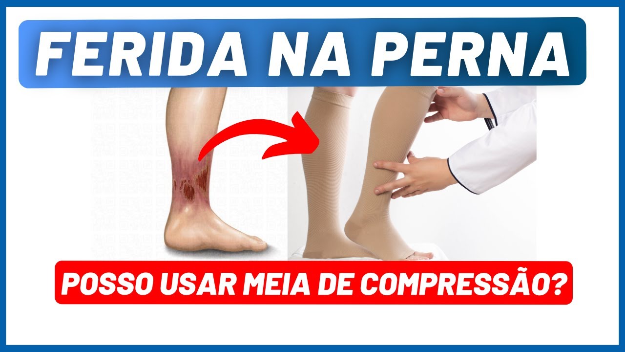 Ferida na perna: posso usar meia de compressão? - Dr. Alex Vascular