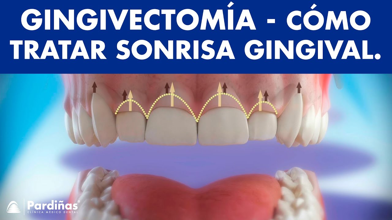 Gingivectomía - Tratamiento de la sonrisa gingival  o exceso de encía ©