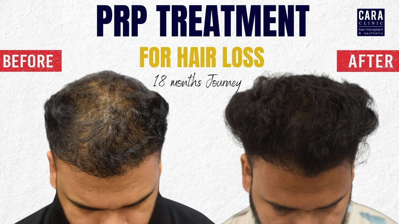 PRP hair loss treatment before and after results