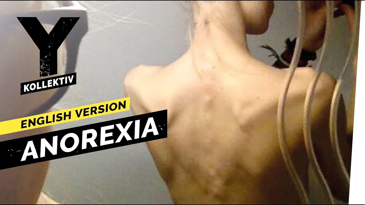 Anorexia &ndash; Weight-Loss Obsession I Y-Kollektiv English Version