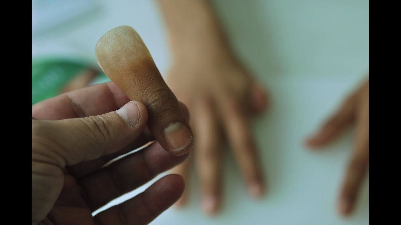 Protesis para dedo pulgar (thumb prosthesis), No. 94