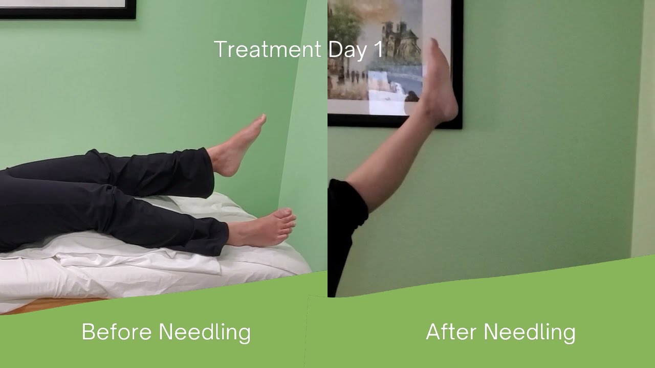 How many Scalp Acupuncture sessions does it take to see improvement in Multiple Sclerosis?