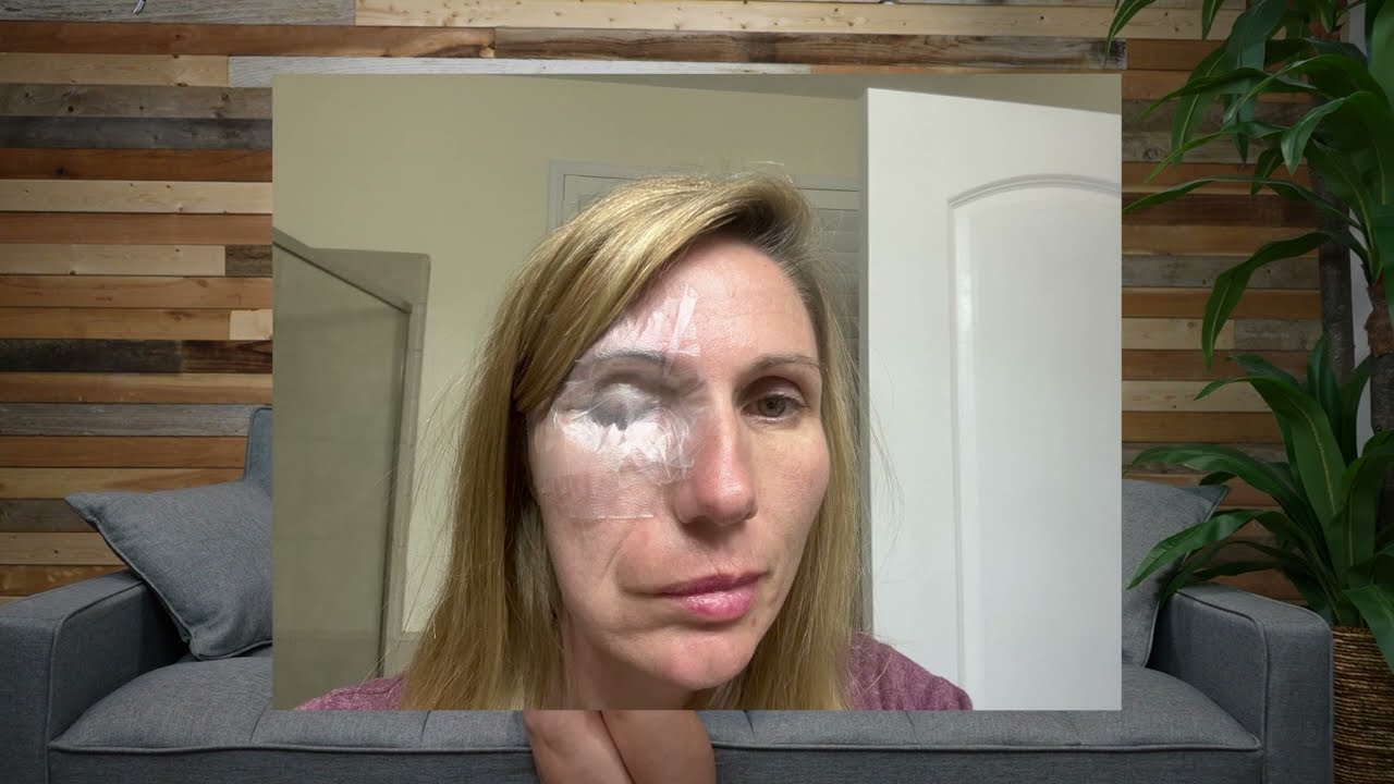 Facial Paralysis Reanimation: How do you handle having more surgery PT 2