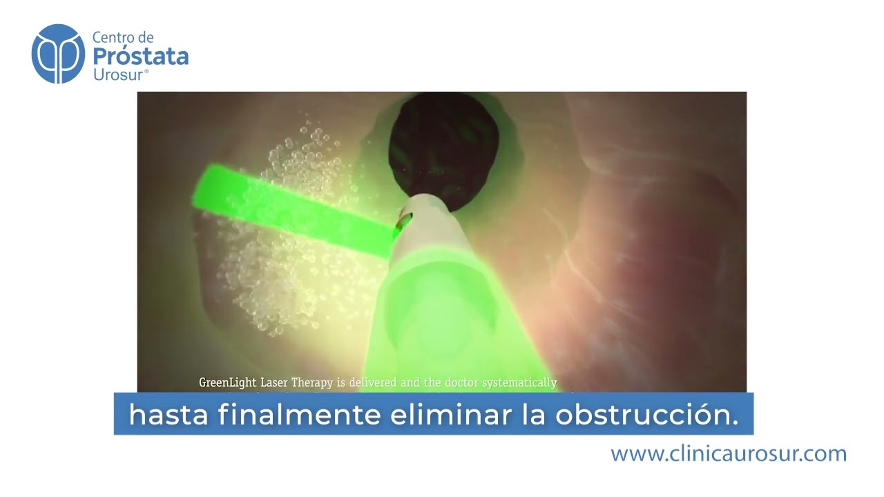 Fotovaporizaci&oacute;n de pr&oacute;stata con l&aacute;ser verde