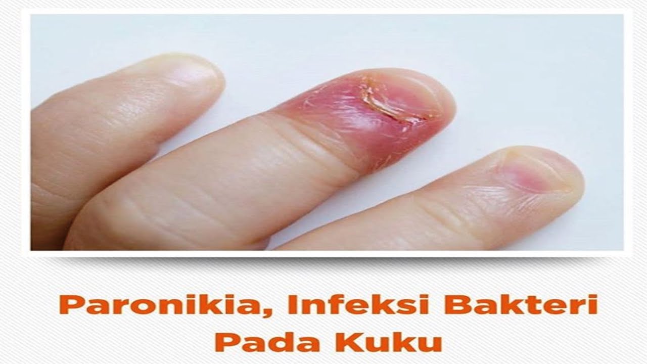 PARONIKIA, Definisi, Gejala, Penyebab, Pengobatan, Komplikasi dan Pencegahan