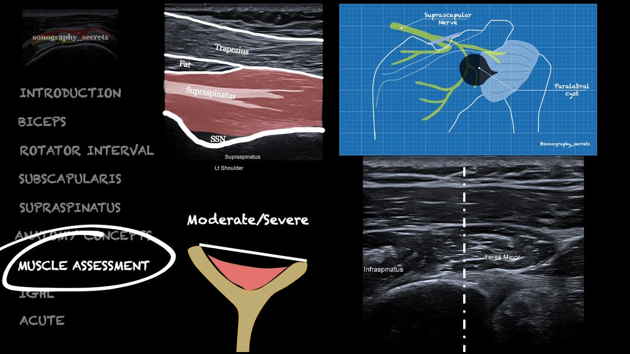 Muscle Assessment of the Rotator Cuff