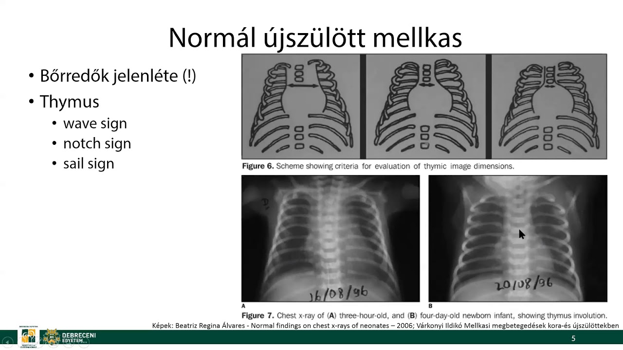 Normál újszülött mellkas, újszülöttkori kórképek
