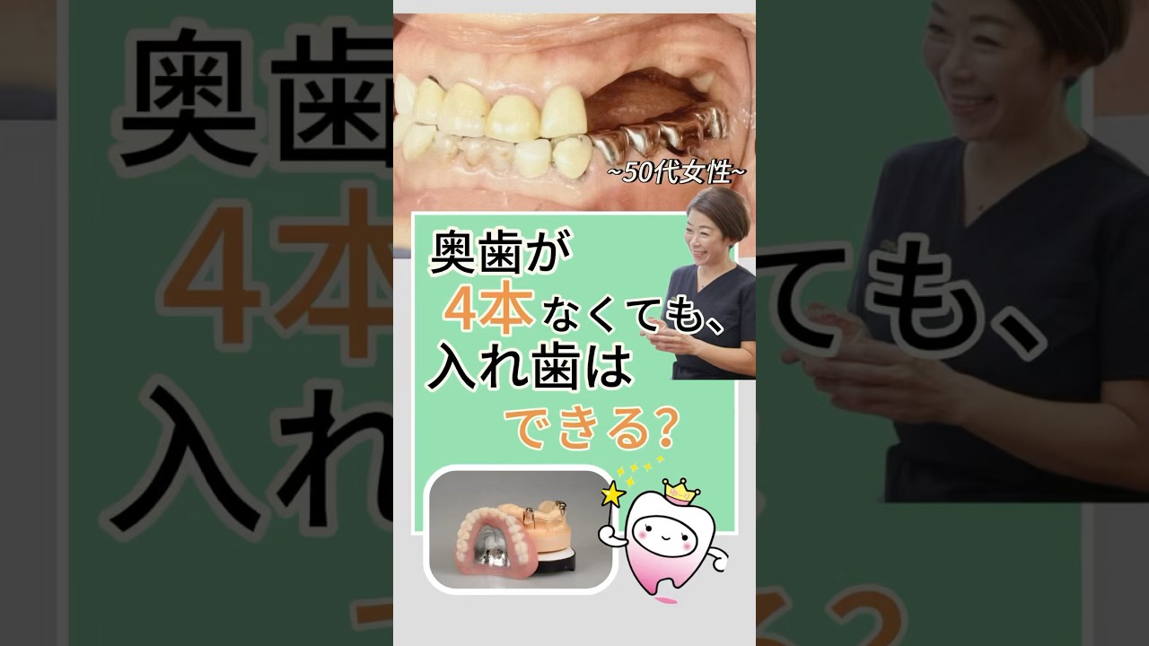 奥歯が4本なくても入れ歯はできる？ #ドイツ式入れ歯 #入れ歯 #歯医者 #仮歯 #稲葉歯科医院