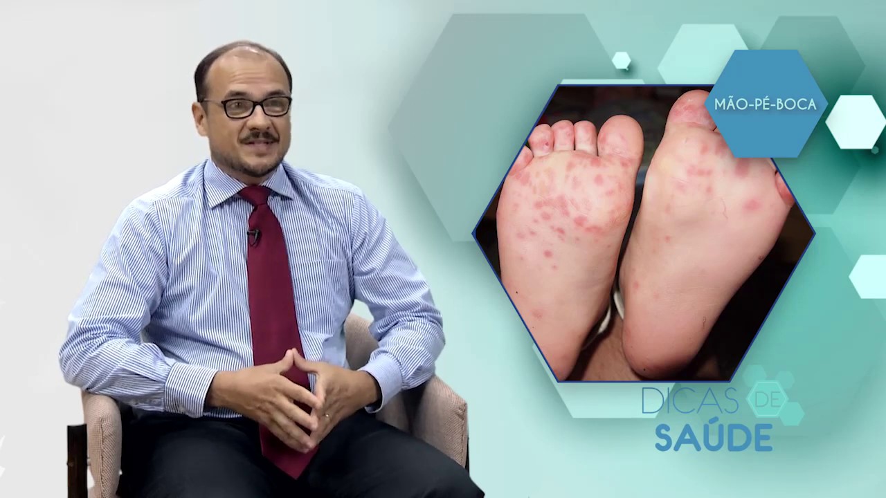 DOENÇA MÃO-PÉ-BOCA | Dicas de Saúde: Dr. Cláudio Cunha