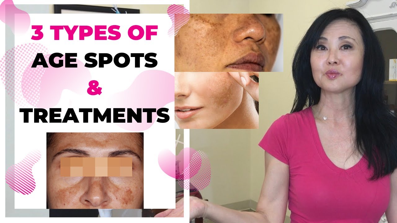 Age Spots vs Skin Cancer- 3 Types