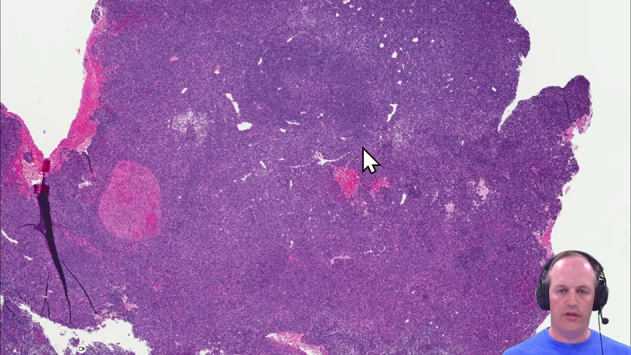 Guide to Pediatric Small Round Blue Cell Tumors - Synovial Sarcoma