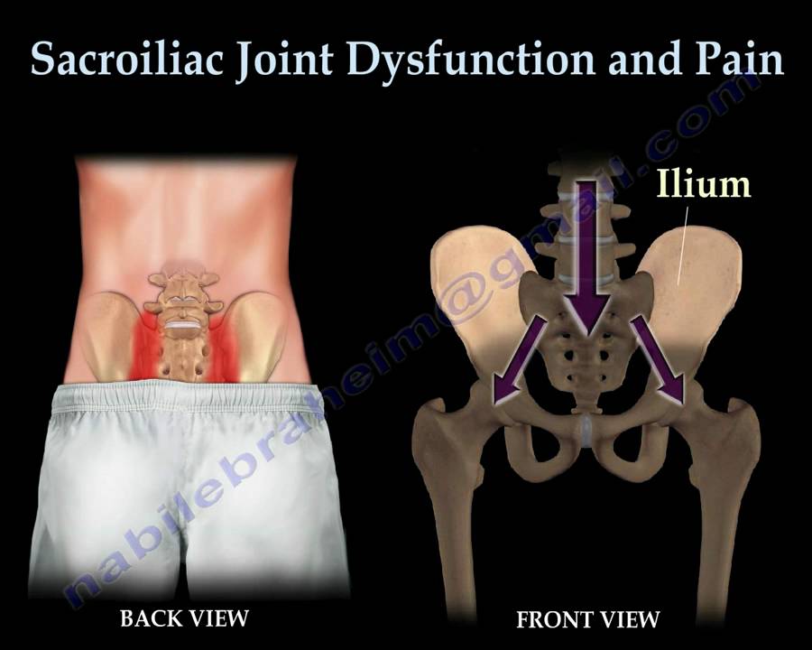 Sacroiliac Joint Dysfunction Animation - Everything You Need To Know - Dr. Nabil Ebraheim, M.D.