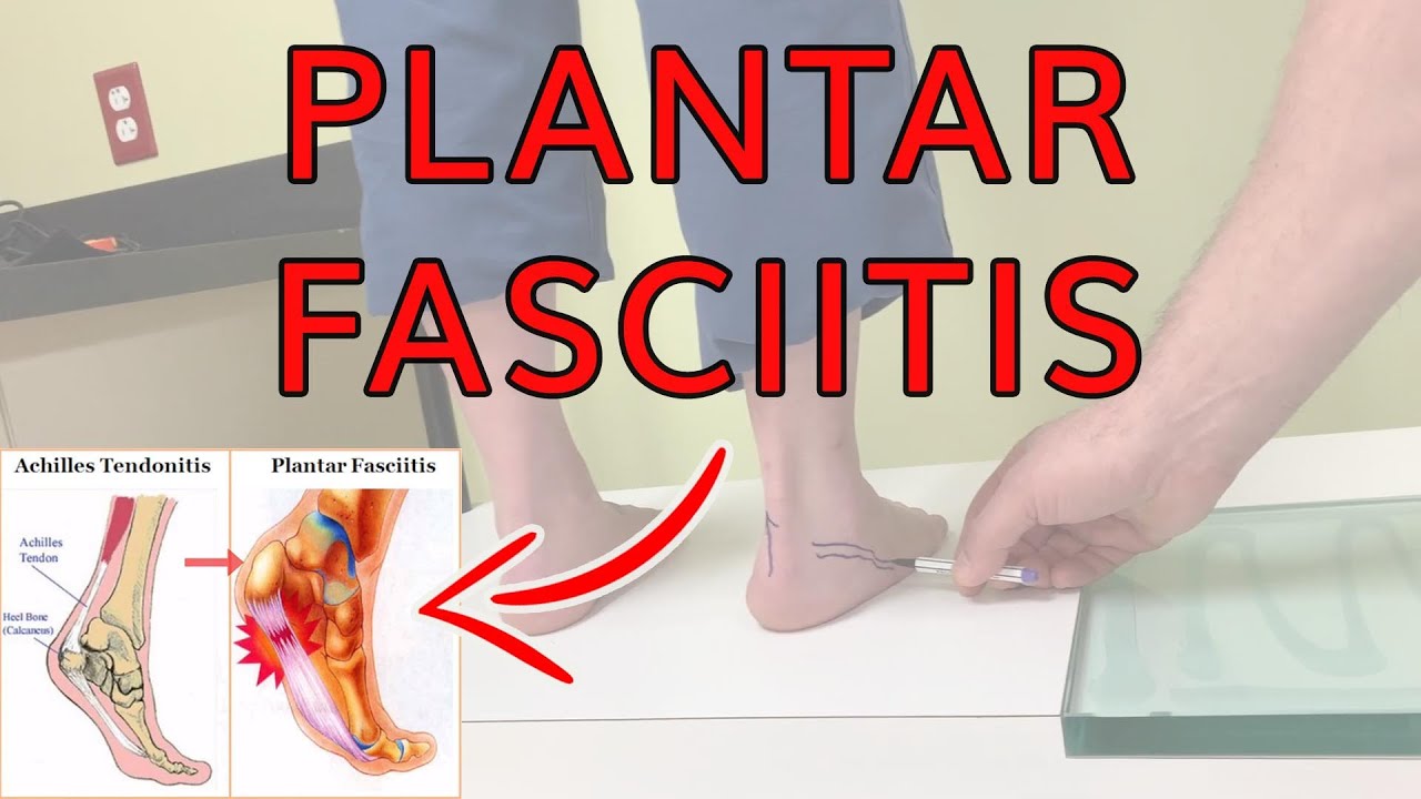Plantar Fasciitis Diagnosis - Dr. Michael Horwitz - Feet For Life Channel