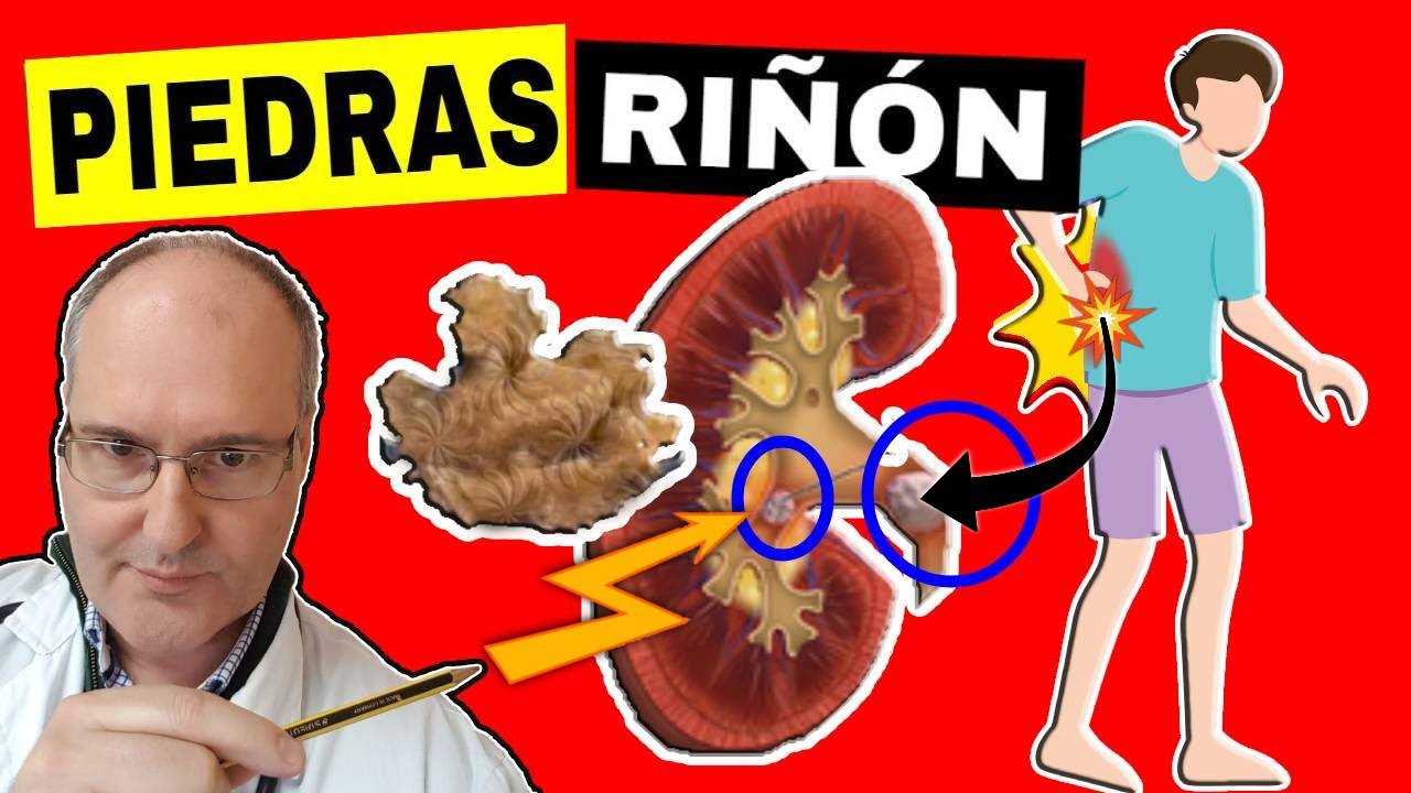 C&Aacute;LCULOS RENALES: S&iacute;ntomas, Causas y Tratamiento de la LITIASIS RENAL (Piedras en el Ri&ntilde;&oacute;n)