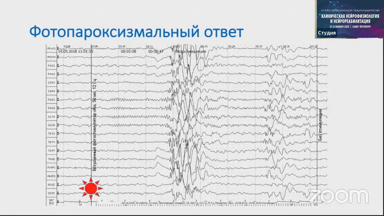 Особенности ЭЭГ при приступах с генерализованным началом. Ноговицын В Ю  Москва.