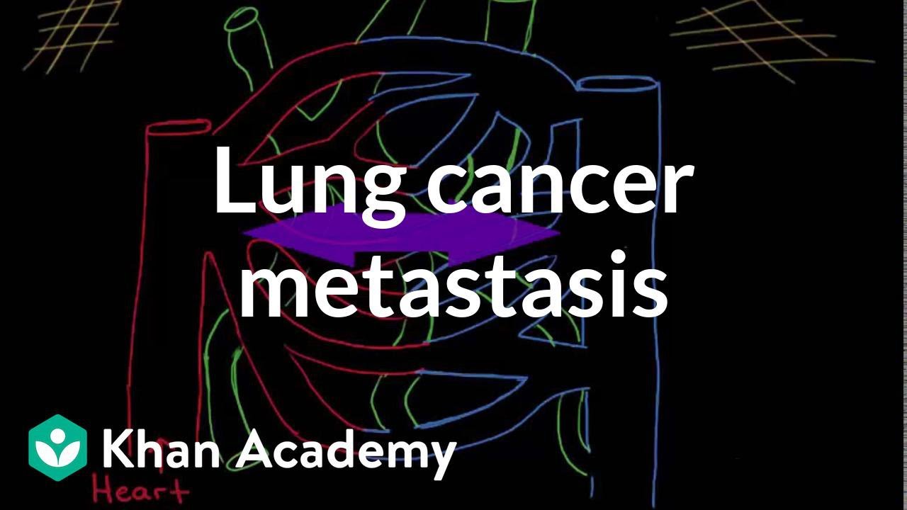 Przerzuty raka płuc | Choroby układu oddechowego | NCLEX-RN | Khan Academy