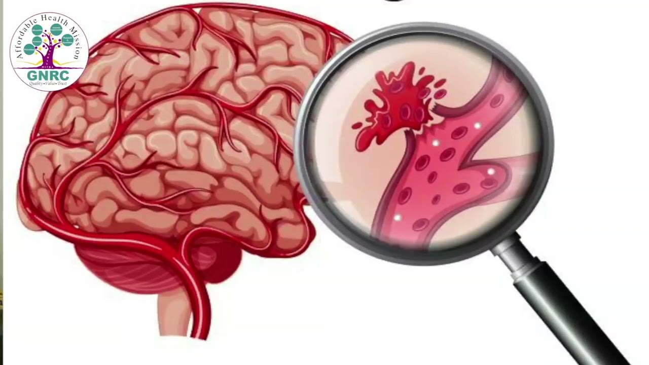 GNRC Hospital | World Stroke Day 2022 | Dr Amit Ranjan Boruah