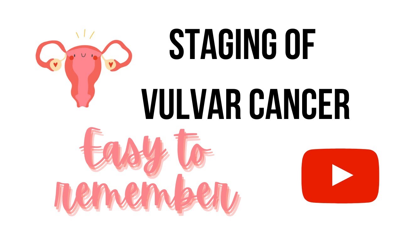 STAGING OF VULVAR CANCER - FIGO