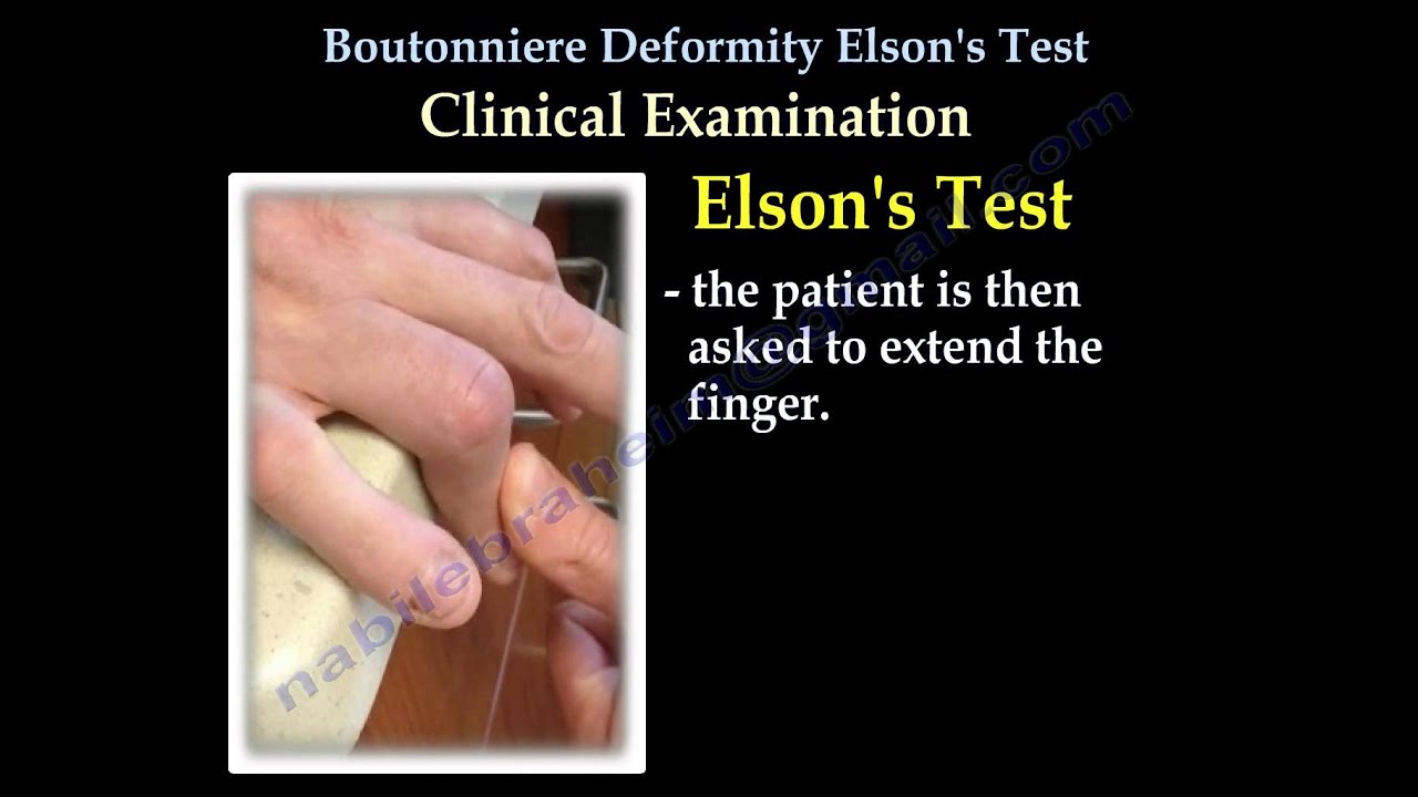 Boutonniere Deformity Elson's Test - Everything You Need To Know - Dr. Nabil Ebraheim