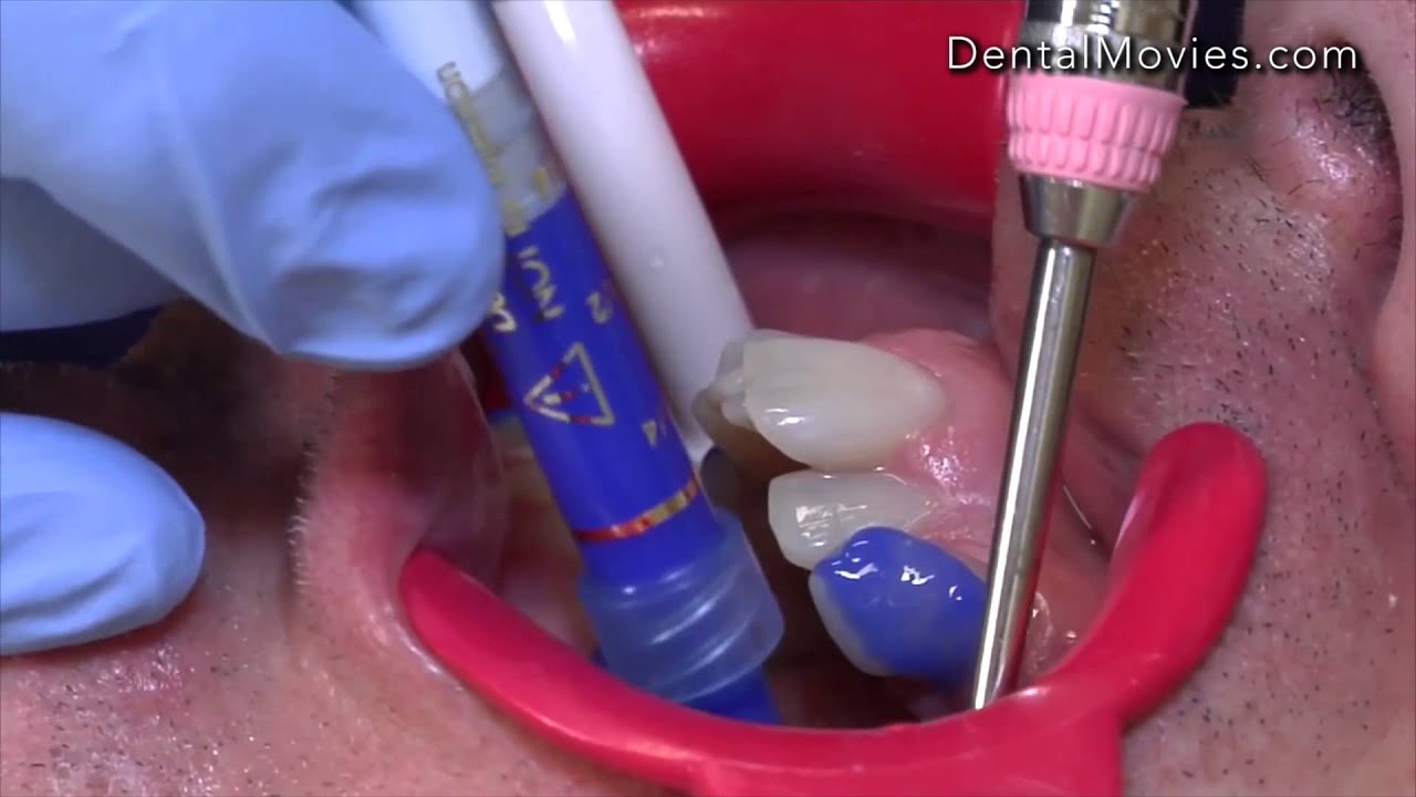 Invisalign - part1
