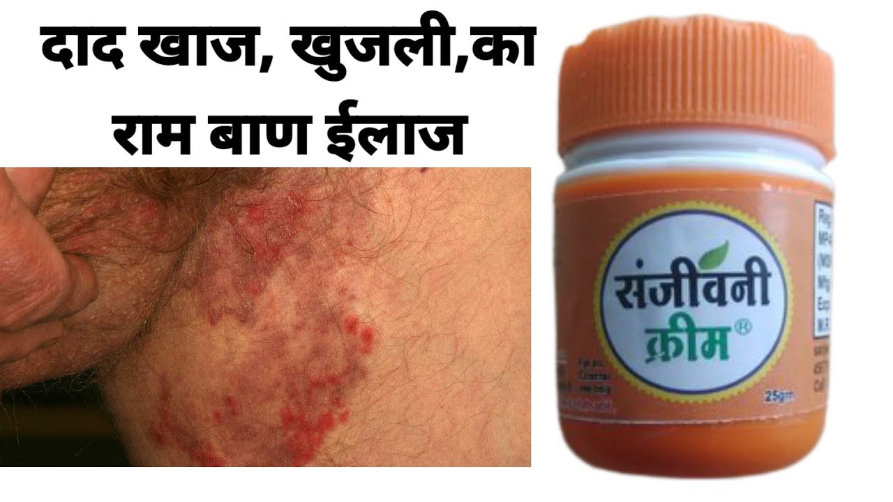 Daad ,khaaj, khujli (fungle infection ) ka ram baan ilaj sanjeevni cream try it effective cream