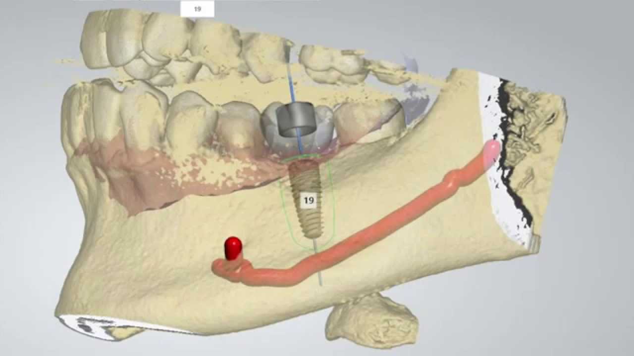 Digital Implant Dentistry