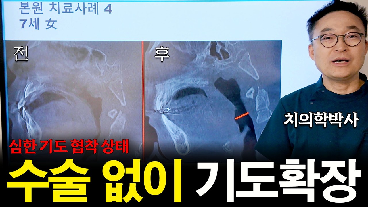 비염수술·축농증 수술까지 했는데 코골이 지속? 코골이수술재발의 진짜 이유