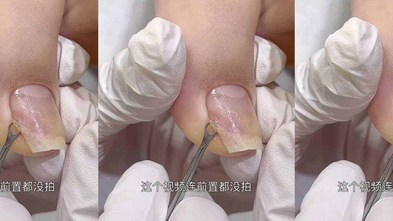 修脚！ 
#美甲分享 #脚趾甲 #修甲 #甲沟炎#嵌甲