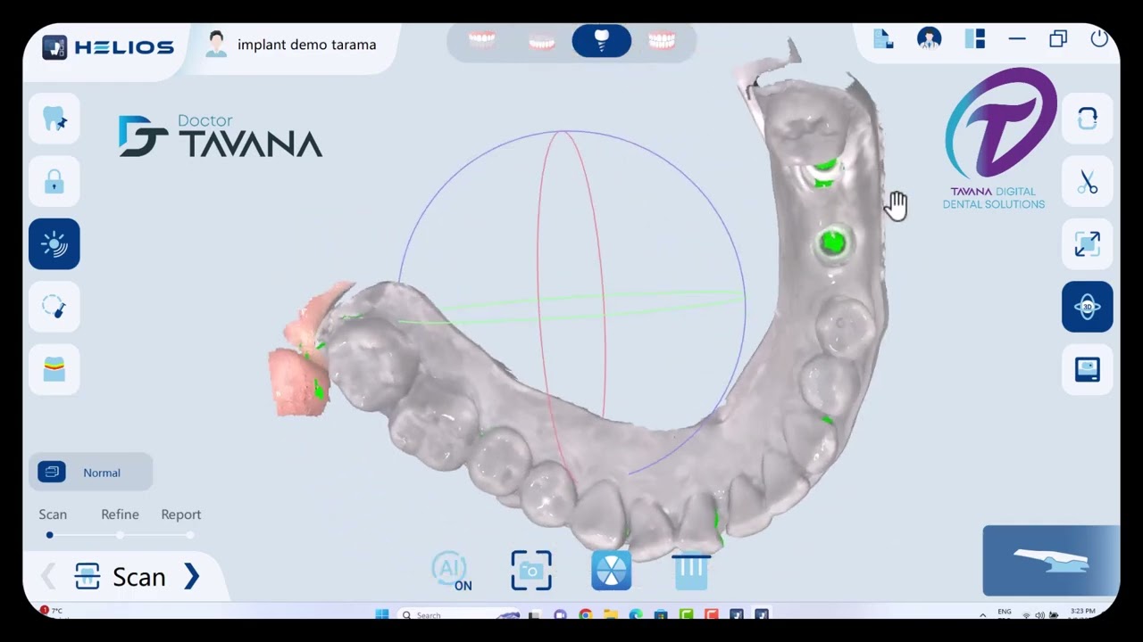 Eighteeth Helios 500 Implant scanning workflow
