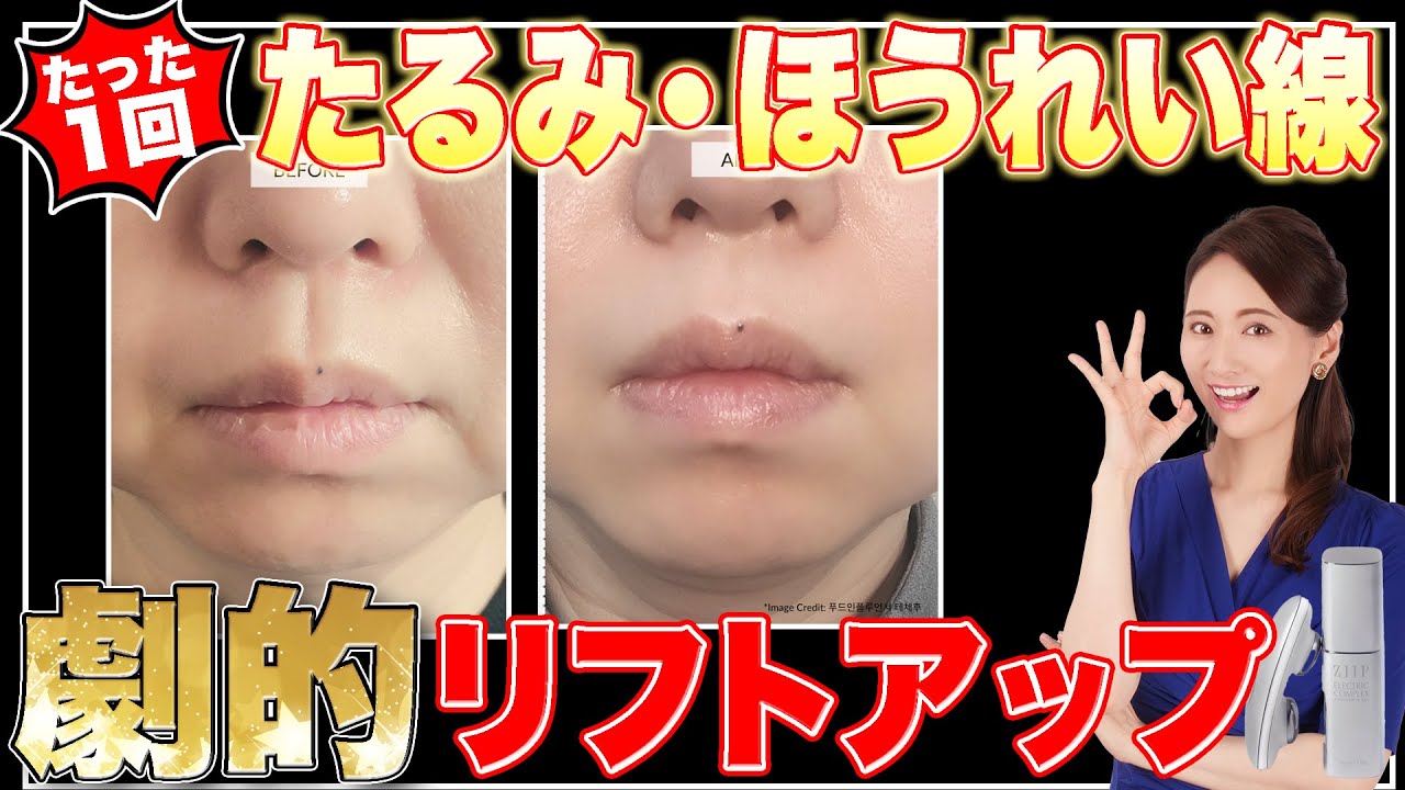 【たるみ撃退】最短4分で別人⁉️37才美容家が1年以上愛用した美顔器を正直レビューします。