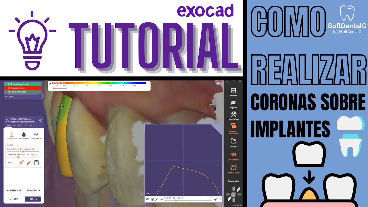 COMO REALIZAR CORONAS SOBRE IMPLANTES EN #EXOCAD 🔥¡TUTORIAL SOFTDENTALC!🔥