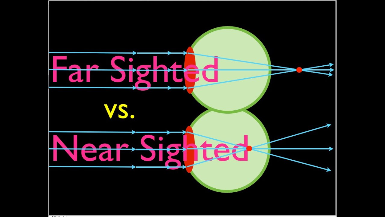 Farsighteness vs. Nearsightedness, An Explanation