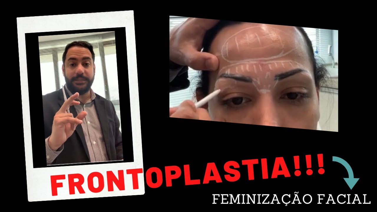 Frontoplastia Óssea em Feminização Facial