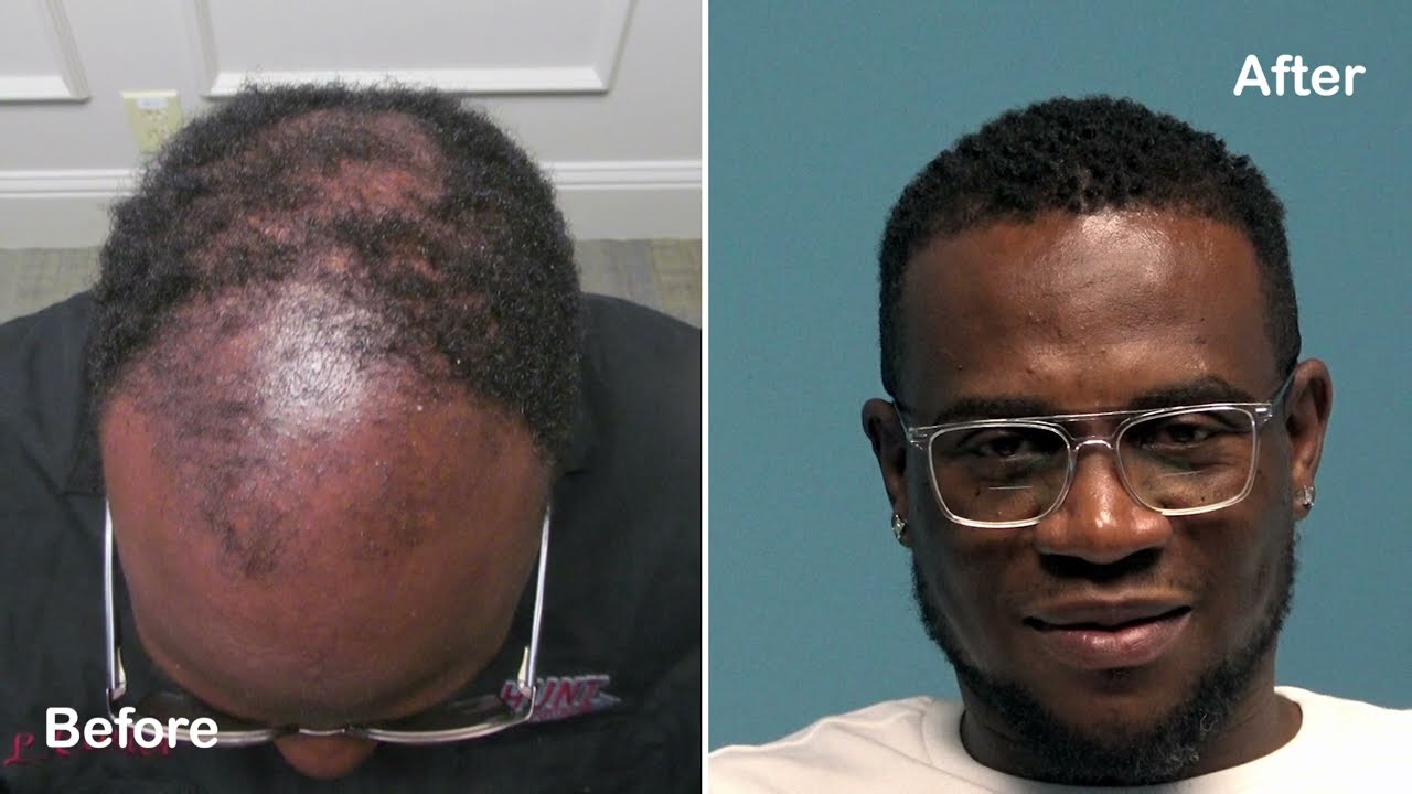 Amazing FUE Hair Transplant on African American Male - 1 Year Later