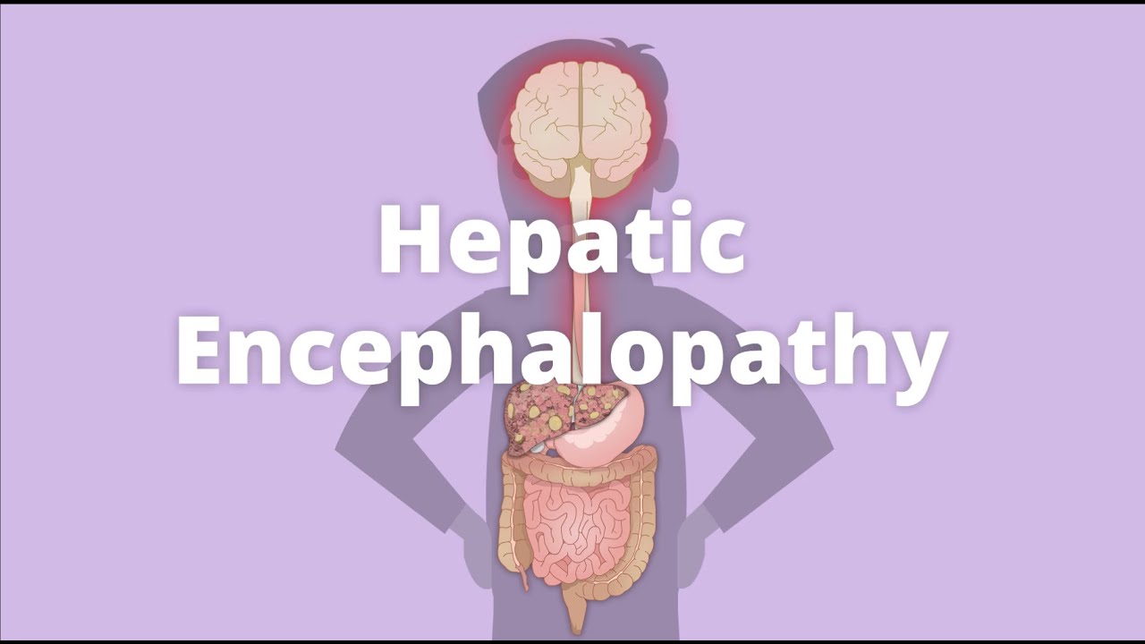 Cirrhosis &ndash; Hepatic encephalopathy