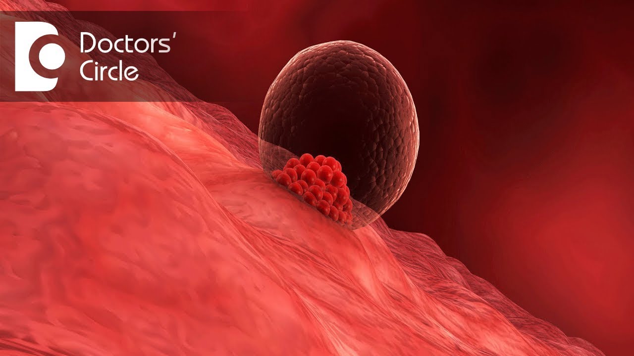 What is the meaning and reasons behind Implantation Failure? - Dr. Nirmala T S