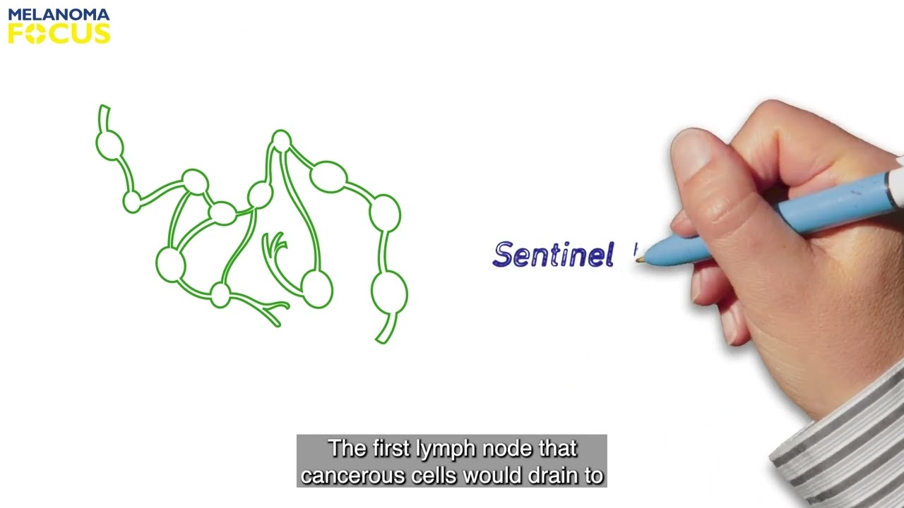 Understanding Sentinel Lymph Node Biopsy - 1 of 2