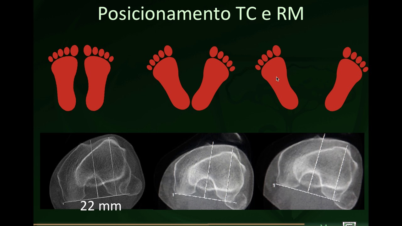 Instabilidade patelofemoral TC e RM