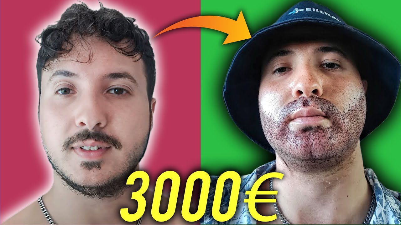 TRAPIANTO DI BARBA DI 4200 UF DA ELITHAIR - la storia di Luca