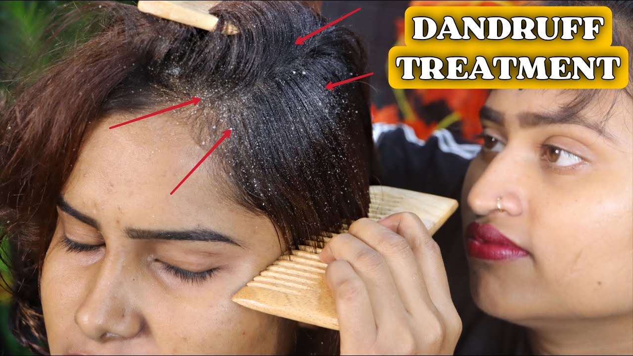 Dandruff Remove | Satisfying Dandruff Scratching with Comb | Dandruff Treatment | ASMR