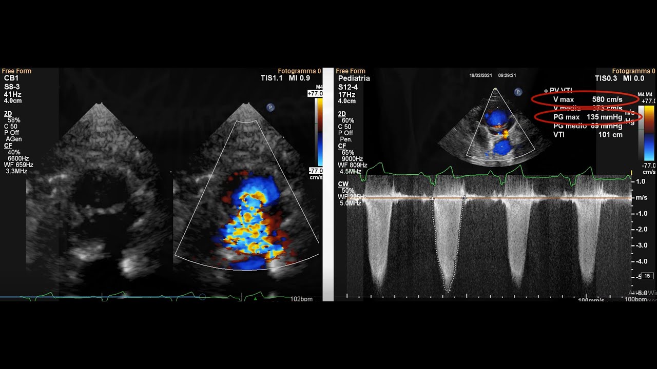 Un difficile caso di stenosi polmonare - TEAM CARDIO GRAN SASSO