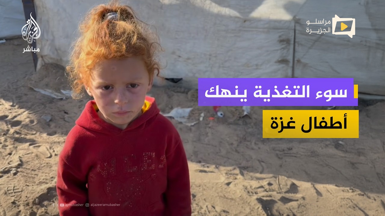 سوء التغذية يهدد حياة أطفال مخيمات النزوح في غزة