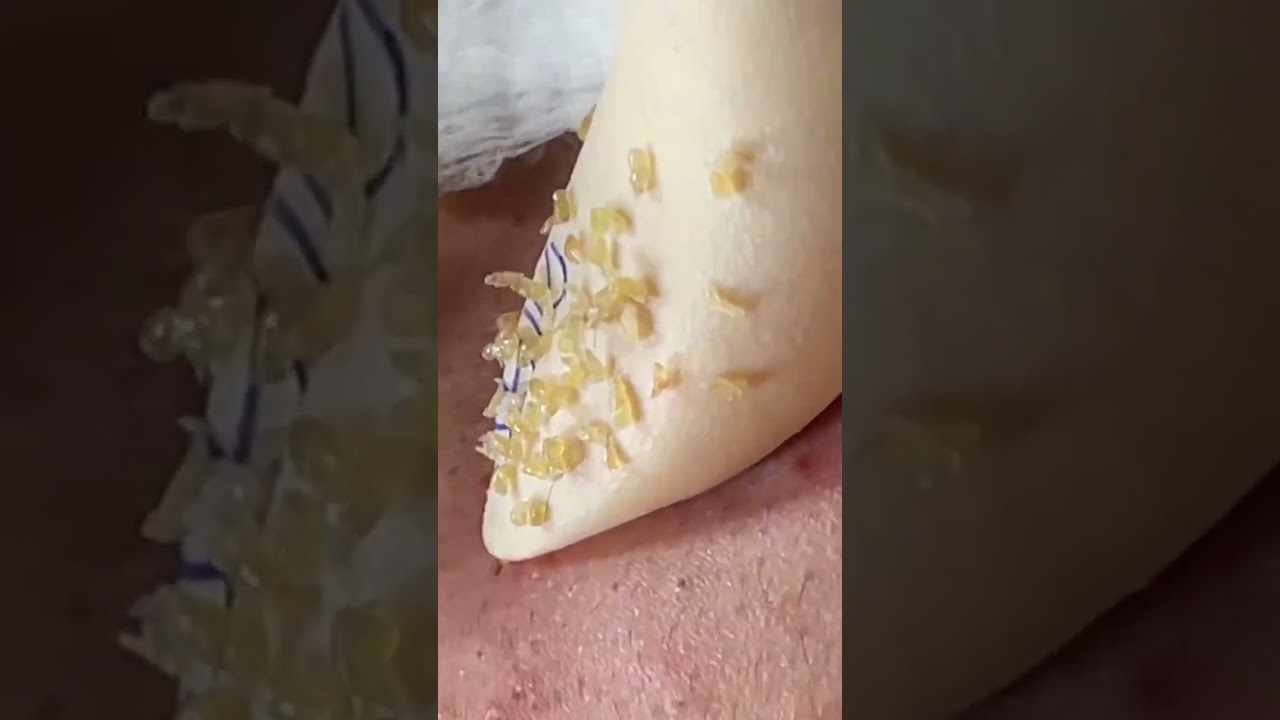#TextBlackheads Removal  #Text Relax | satisfying   With Din Spa 2025 &hearts;️ 🐥 😇