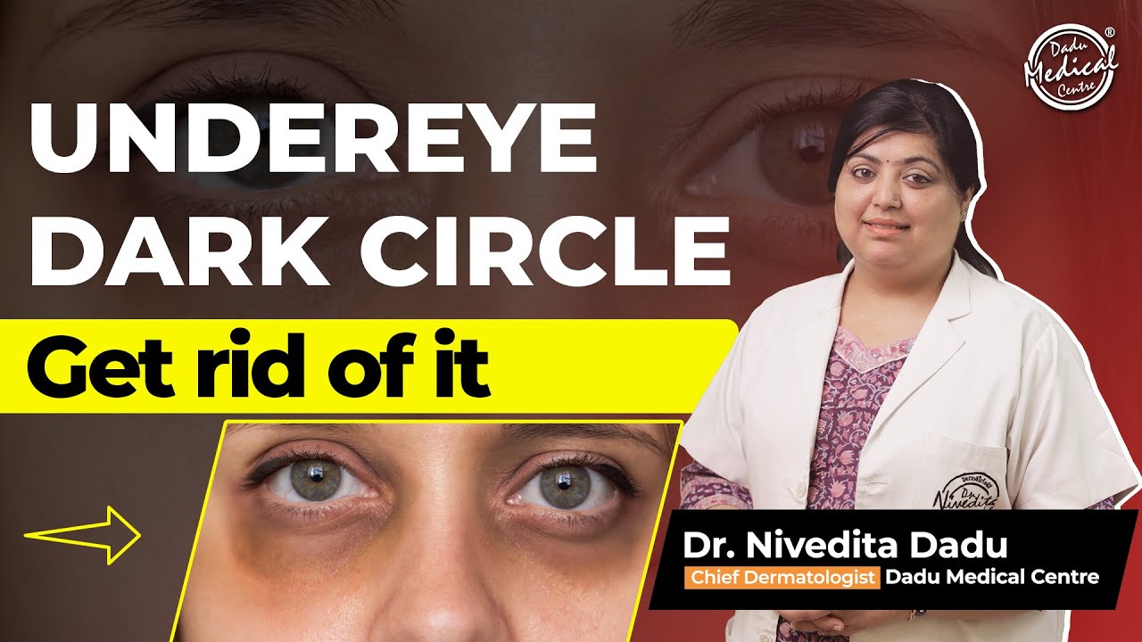 How to get rid of Dark Circles? | Dark Circles Treatment in Delhi | Dadu Medical Centre