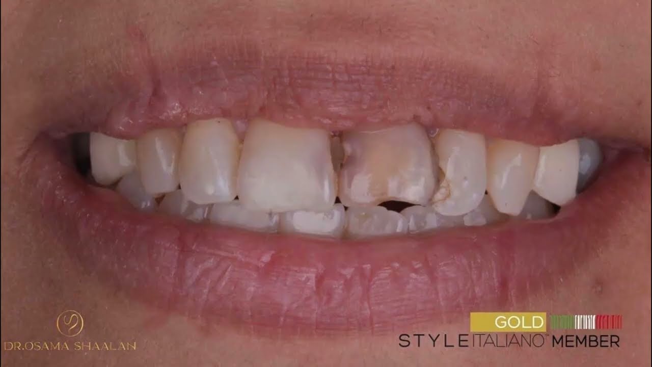 Two years and half follow up for composite bonding