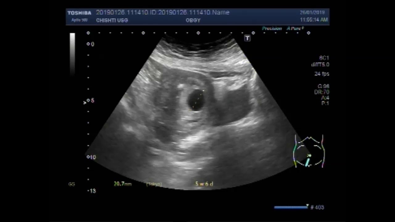 Ultrasound Video showing a Gestational sac in the uterus without a fetal pole in it.