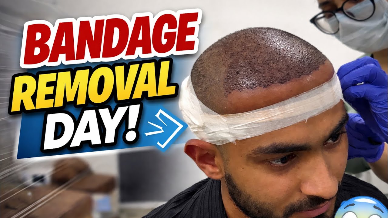 Hair Transplant Bandage Removal | First Look After Surgery. #youtubeshorts#viralshorts 